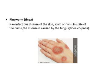 • Ringworm (tinea)
is an infectious disease of the skin, scalp or nails. In spite of
the name,the disease is caused by the fungus(tinea corporis).
 