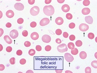 Megaloblasts in
folic acid
deficiency
 