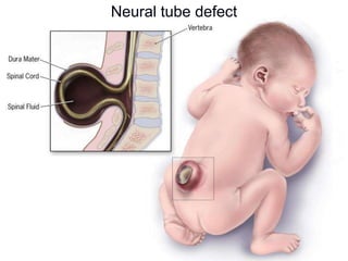 Neural tube defect
 