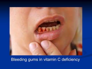 Bleeding gums in vitamin C deficiency
 
