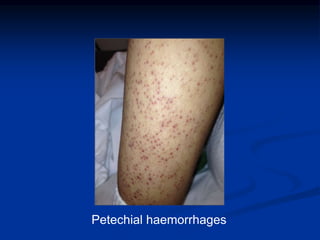 Petechial haemorrhages
 