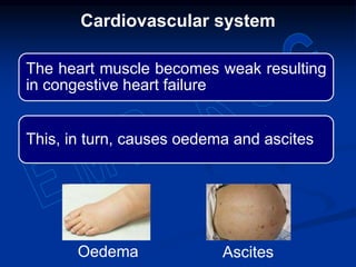 The heart muscle becomes weak resulting
in congestive heart failure
This, in turn, causes oedema and ascites
Cardiovascular system
Oedema Ascites
 