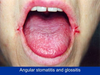Angular stomatitis and glossitis
 