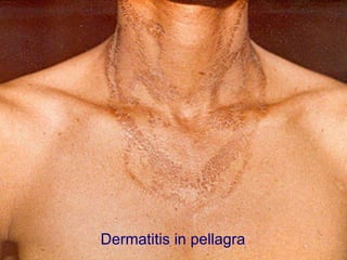 Dermatitis in pellagra
 