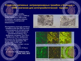 Структура нативных интракоронарных тромбов у больных с
ОИМ: значение для антитромботической терапии
Впервые изучены тромбы,
полученные у больных с ОИМ во
время первичного ЧКВ путем
аспирации, методами иммуно-
гистохимии и электронной
микроскопии.
Исследована структура нативных
тромбов из КА при ОКС (ex vivo)
и установлена их негомогенная
структура: отдельные места
скоплений активных ТЦ с
фибрином, активных ТЦ и ЛЦ с
фибрином и ЛЦ с фибрином.
Большинство ЛЦ представлено
гранулярными формами: НФ –
89,5% и МЦ 10,5%, все -
CD11b+; авторы считают, что он
служит Рц к фибрину.
Не обнаружены CD3+ (Т-Лц) и
CD20+ (В –Лц).
G. Ghimire et al. Alabama Univ.,
USA, ACC, 2013
 