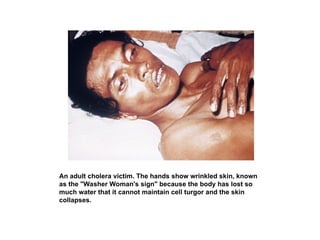 An adult cholera victim. The hands show wrinkled skin, known
as the "Washer Woman's sign" because the body has lost so
much water that it cannot maintain cell turgor and the skin
collapses.
 