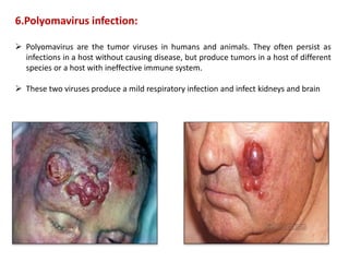 6.Polyomavirus infection:
 Polyomavirus are the tumor viruses in humans and animals. They often persist as
infections in a host without causing disease, but produce tumors in a host of different
species or a host with ineffective immune system.
 These two viruses produce a mild respiratory infection and infect kidneys and brain
 