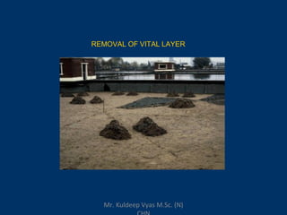 REMOVAL OF VITAL LAYER
Mr. Kuldeep Vyas M.Sc. (N)
 