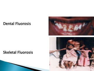 Dental Fluorosis
Skeletal Fluorosis
 
