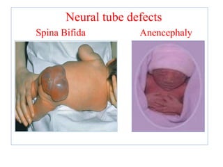 Neural tube defects
Spina Bifida Anencephaly
 
