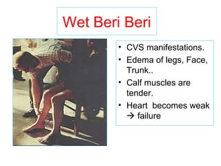 Wet Beri Beri
• CVS manifestations.
• Edema of legs, Face,
Trunk..
• Calf muscles are
tender.
• Heart becomes weak
 failure
 