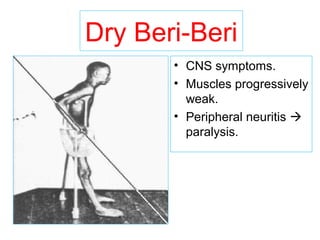 Dry Beri-Beri
• CNS symptoms.
• Muscles progressively
weak.
• Peripheral neuritis 
paralysis.
 