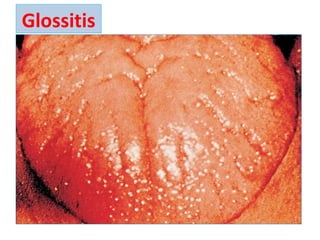 Glossitis
 