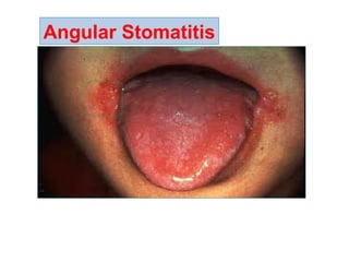 Angular Stomatitis
 