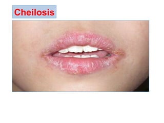 Cheilosis
 
