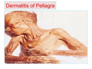Dermatitis of Pellagra
 