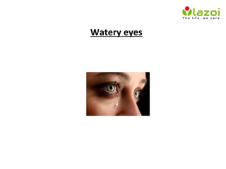 Watery eyes
 