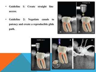 • Guideline 1: Create straight line
access.
• Guideline 2: Negotiate canals to
patency and create a reproducible glide
path.
 
