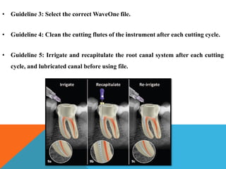 • Guideline 5: Irrigate and recapitulate the root canal system after each cutting
cycle, and lubricated canal before using file.
• Guideline 4: Clean the cutting flutes of the instrument after each cutting cycle.
• Guideline 3: Select the correct WaveOne file.
 