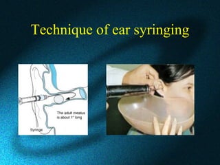 Technique of ear syringing
 