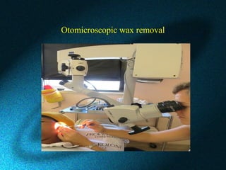 Otomicroscopic wax removal
 