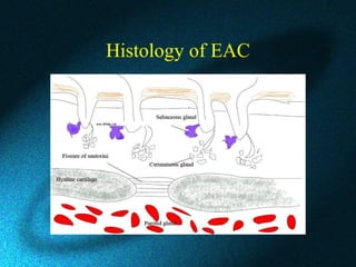 Histology of EAC
 
