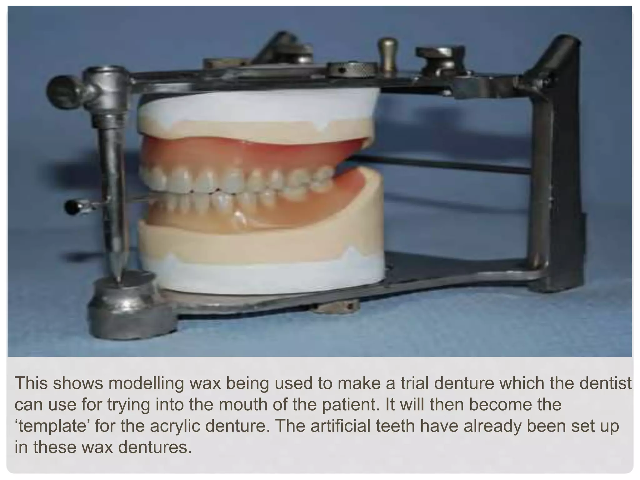 This shows modelling wax being used to make a trial denture which the dentist
can use for trying into the mouth of the patient. It will then become the
‘template’ for the acrylic denture. The artificial teeth have already been set up
in these wax dentures.
 