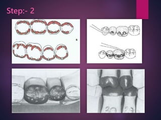 Wax patterns fabrication for fixed partial dentures | PPTX