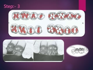 Wax patterns fabrication for fixed partial dentures | PPTX
