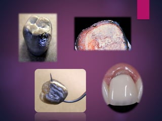 Wax patterns fabrication for fixed partial dentures | PPTX
