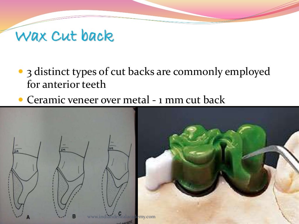 Wax patterns in fpd/ dentistry course in india