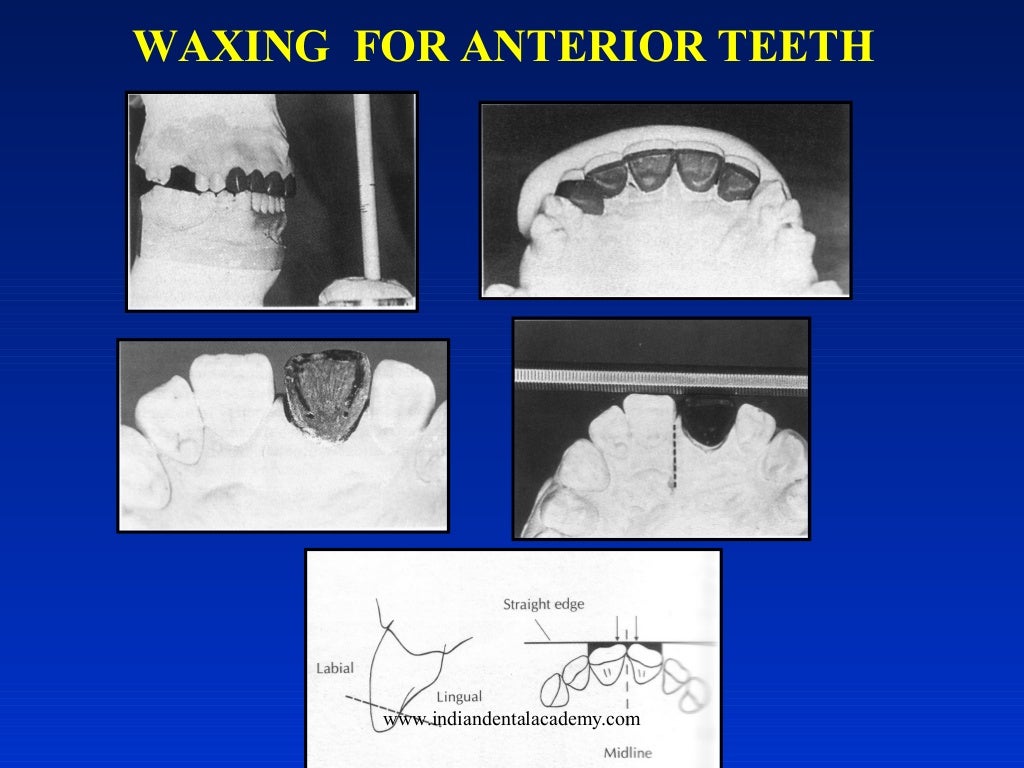 Wax patterns in fpd/ dental crown & bridge courses