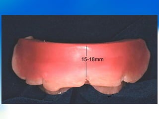 Wax rims & jaw relations