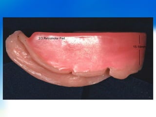 Wax rims & jaw relations