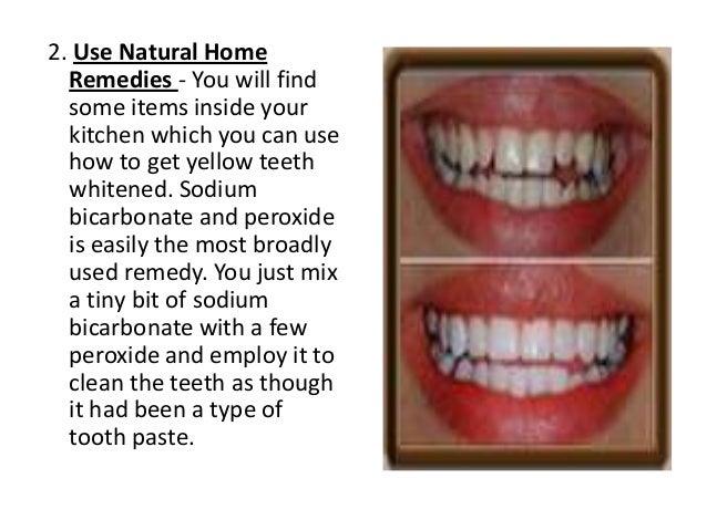Can Natural Yellow Teeth Be Whitened Can Natural Yellow Teeth Be Whitened