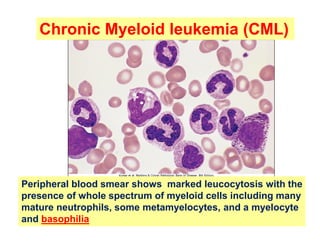 Chronic Myeloid leukemia (CML)
Peripheral blood smear shows marked leucocytosis with the
presence of whole spectrum of myeloid cells including many
mature neutrophils, some metamyelocytes, and a myelocyte
and basophilia
 