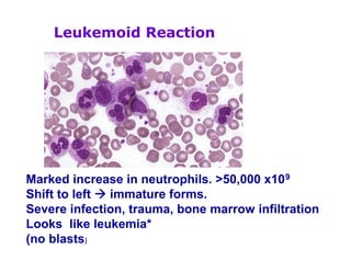 Leukemoid Reaction
Marked increase in neutrophils. >50,000 x109
Shift to left  immature forms.
Severe infection, trauma, bone marrow infiltration
Looks like leukemia*
(no blasts)
 