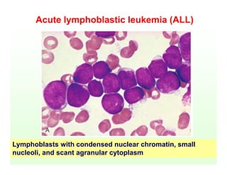 Acute lymphoblastic leukemia (ALL)
Lymphoblasts with condensed nuclear chromatin, small
nucleoli, and scant agranular cytoplasm
 