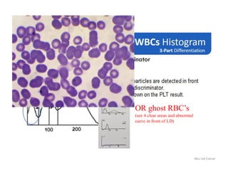 Abu Jad Caesar
OR ghost RBC’s
(see 4 clear areas and abnormal
curve in front of LD)
 