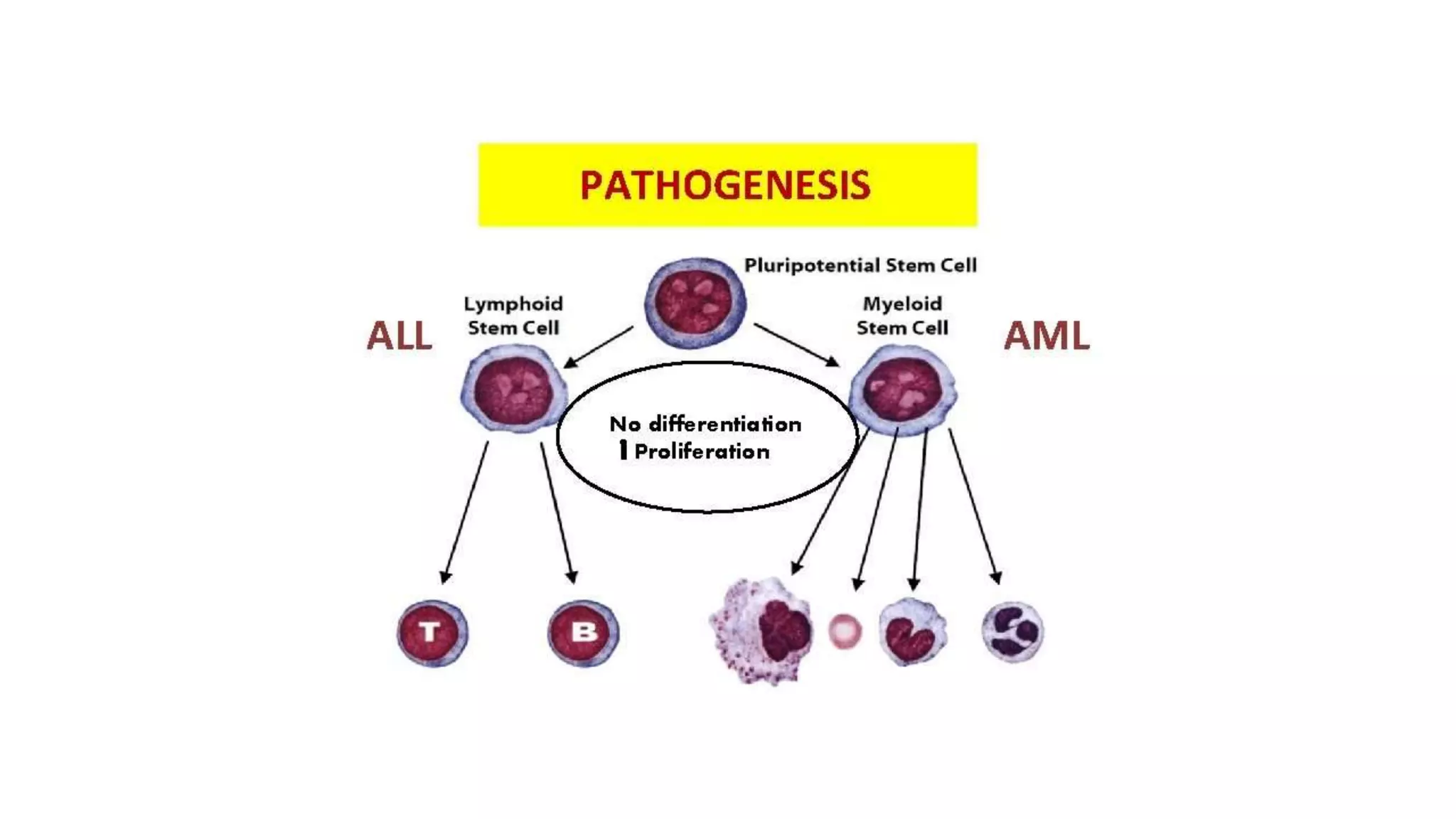 Myeloid neoplasm . Dr. Abhinav Golla , Associate Professor , Lab Director & Consultant Pathologist . Aadhya Medicure Pathlabs .
