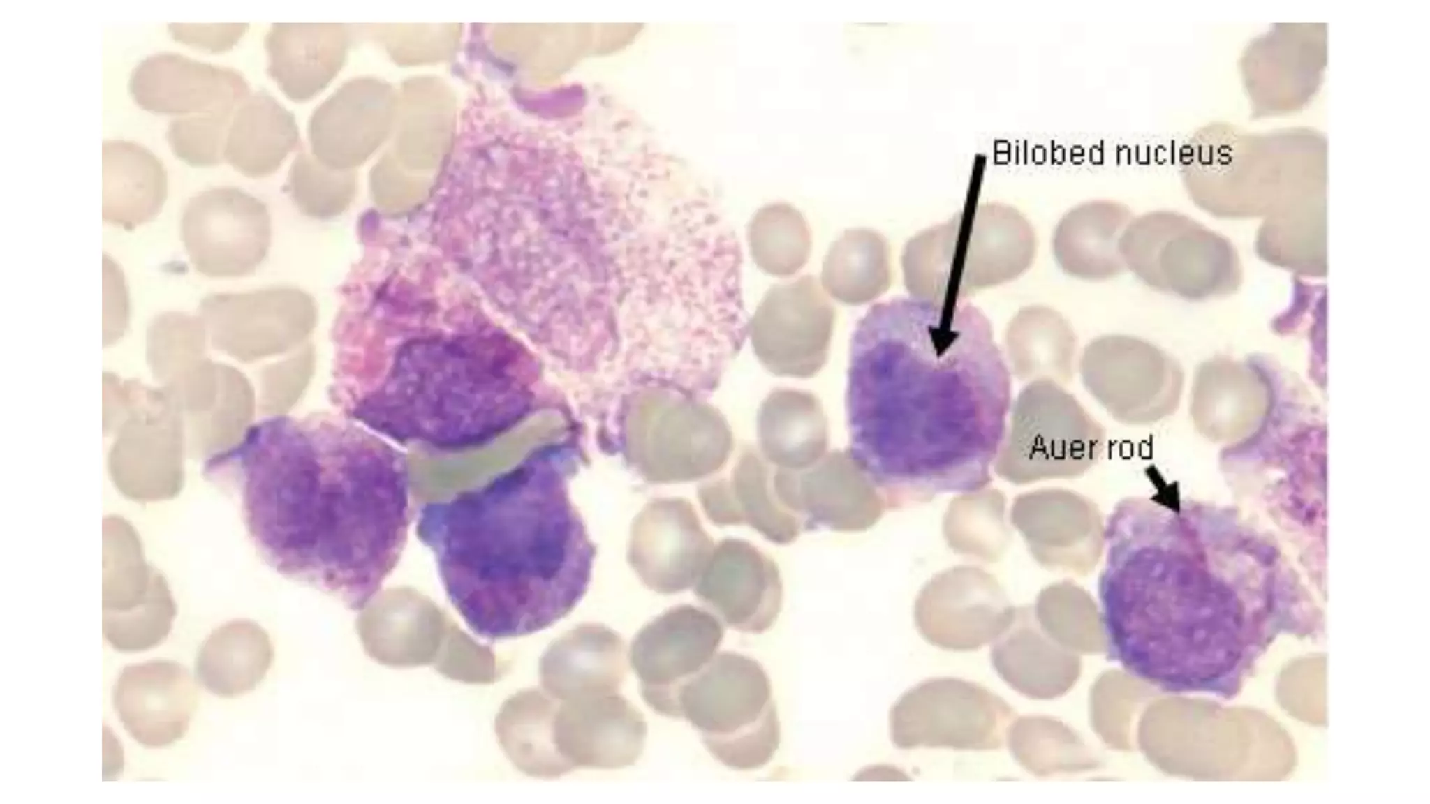 Myeloid neoplasm . Dr. Abhinav Golla , Associate Professor , Lab Director & Consultant Pathologist . Aadhya Medicure Pathlabs .