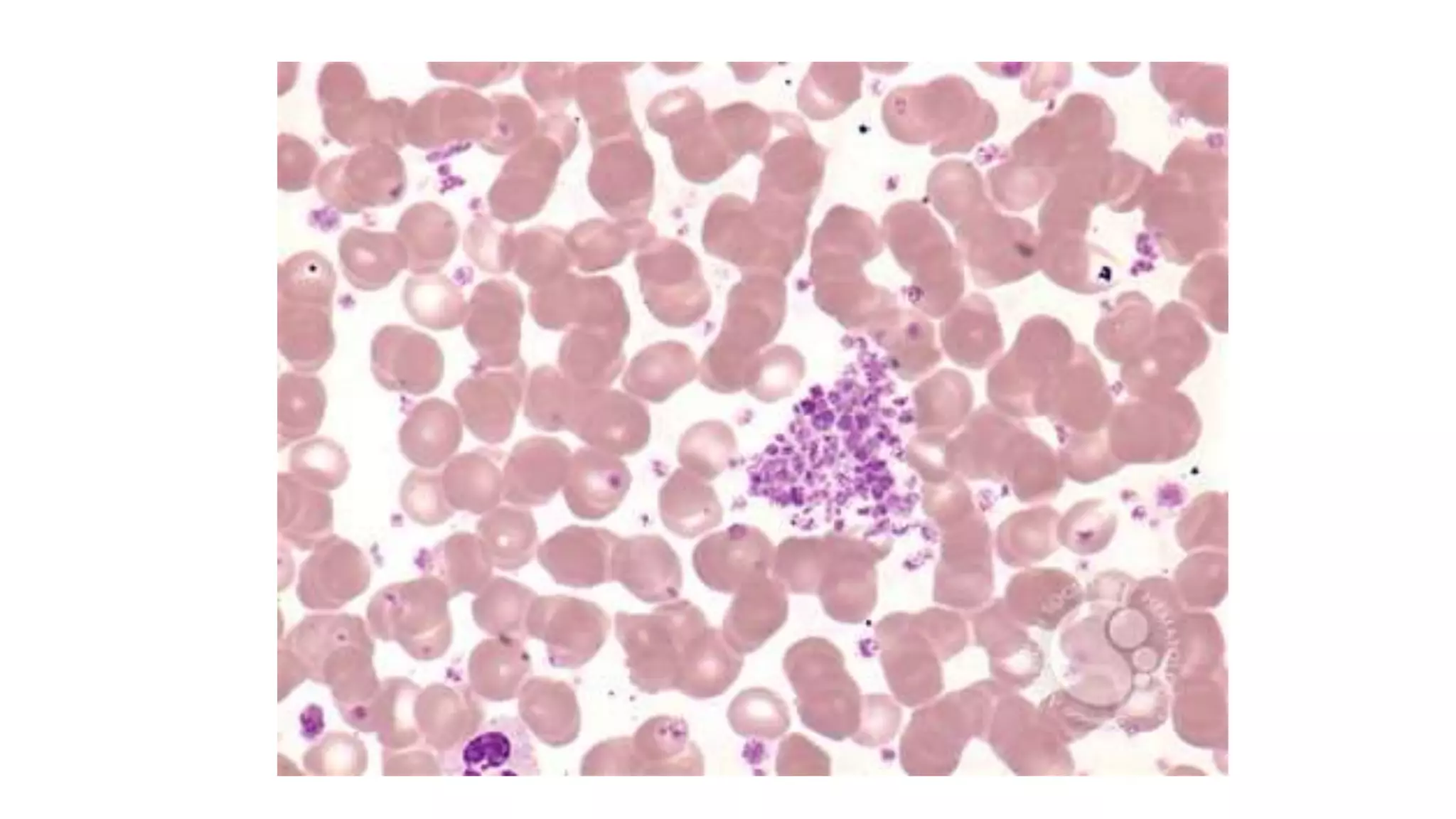 Myeloid neoplasm . Dr. Abhinav Golla , Associate Professor , Lab Director & Consultant Pathologist . Aadhya Medicure Pathlabs .
