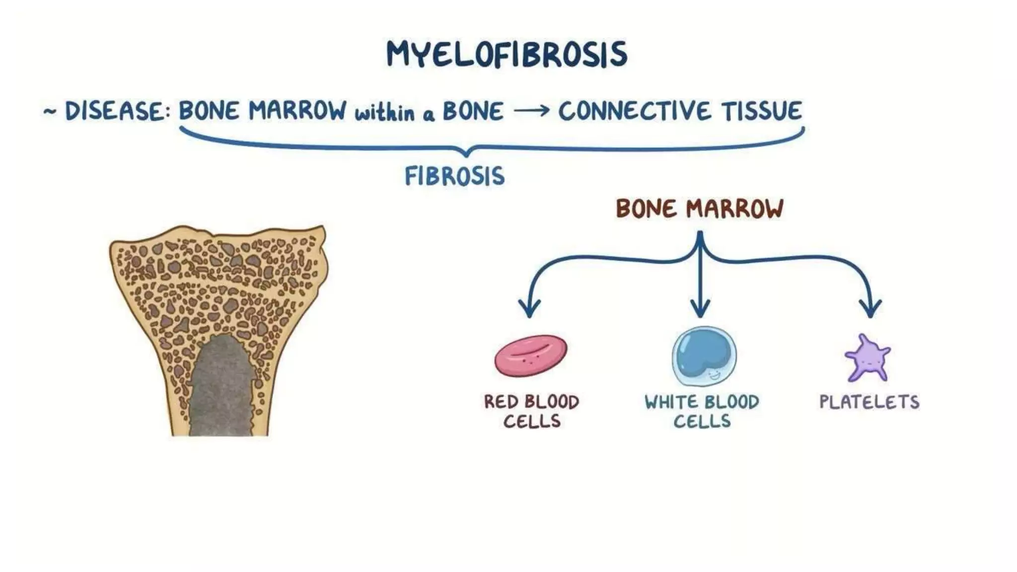 Myeloid neoplasm . Dr. Abhinav Golla , Associate Professor , Lab Director & Consultant Pathologist . Aadhya Medicure Pathlabs .