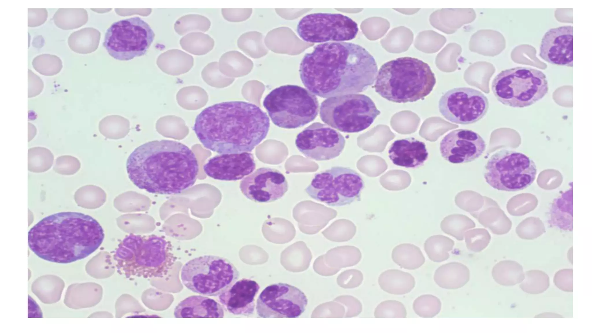 Myeloid neoplasm . Dr. Abhinav Golla , Associate Professor , Lab Director & Consultant Pathologist . Aadhya Medicure Pathlabs .