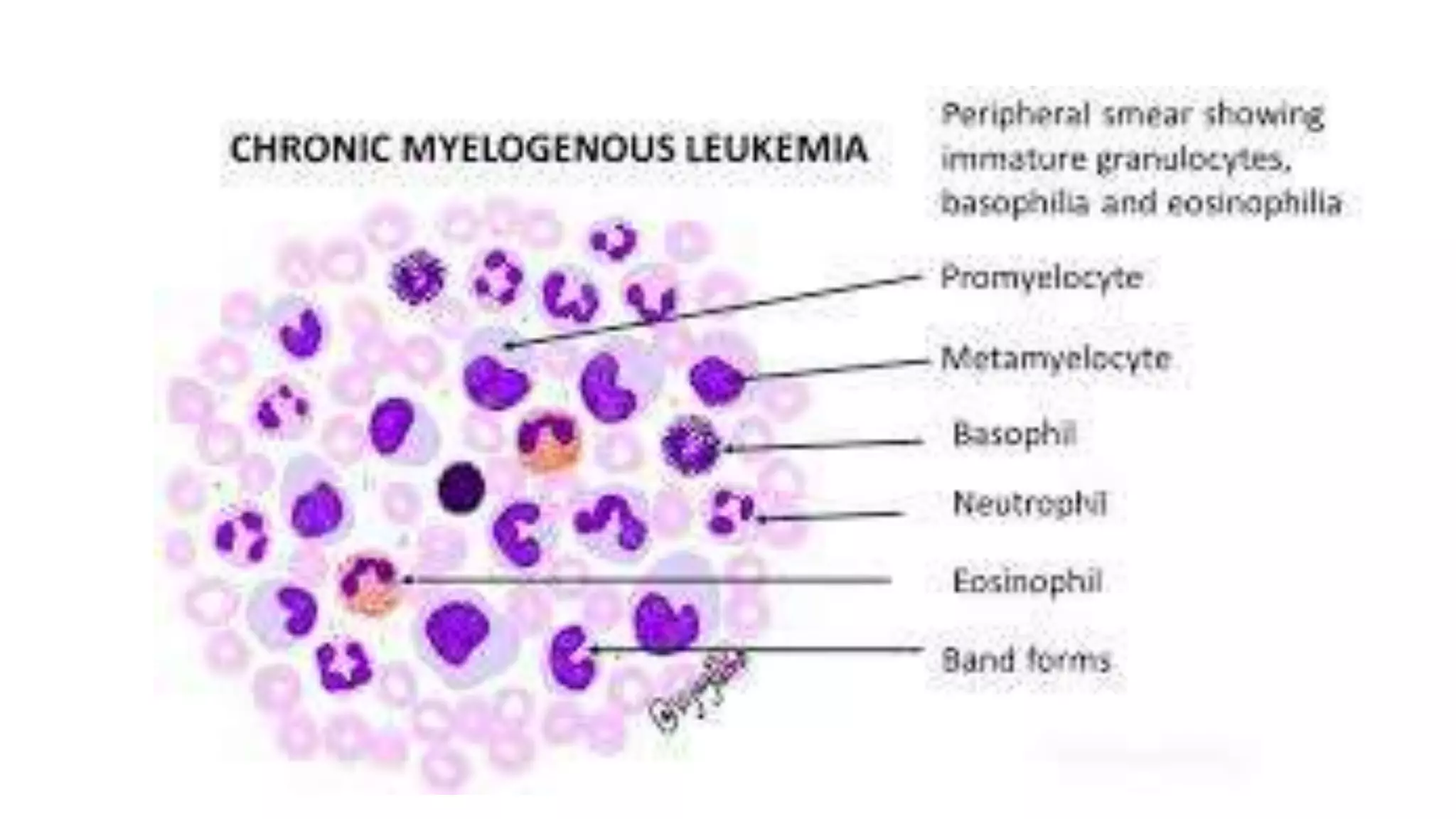Myeloid neoplasm . Dr. Abhinav Golla , Associate Professor , Lab Director & Consultant Pathologist . Aadhya Medicure Pathlabs .