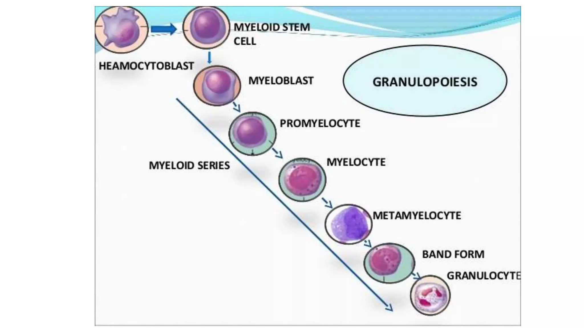 Myeloid neoplasm . Dr. Abhinav Golla , Associate Professor , Lab Director & Consultant Pathologist . Aadhya Medicure Pathlabs .