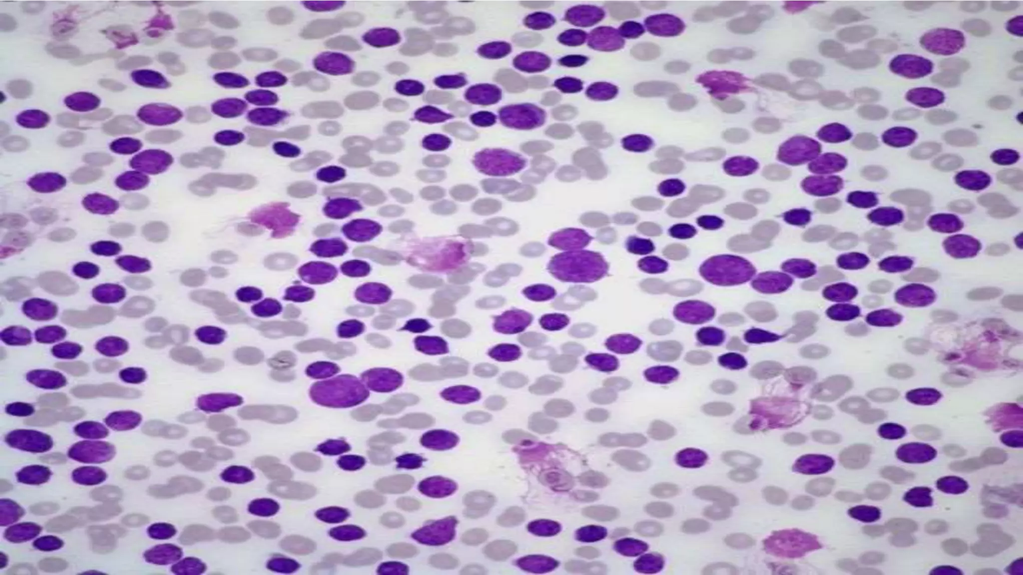 Myeloid neoplasm . Dr. Abhinav Golla , Associate Professor , Lab Director & Consultant Pathologist . Aadhya Medicure Pathlabs .