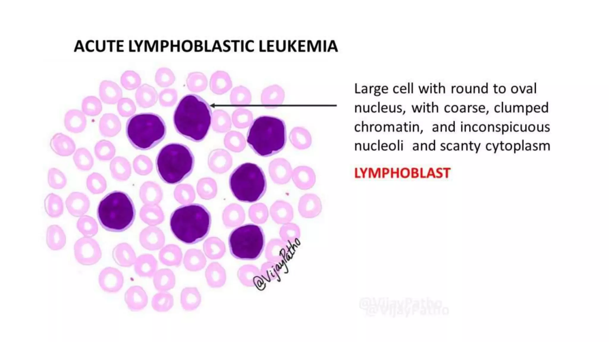 Myeloid neoplasm . Dr. Abhinav Golla , Associate Professor , Lab Director & Consultant Pathologist . Aadhya Medicure Pathlabs .