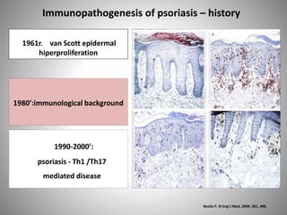 Nestle F. N Engl J Med, 2009, 361, 496.
Immunopathogenesis of psoriasis – history
1980’:immunological background
1990-2000’:
psoriasis - Th1 /Th17
mediated disease
1961r. van Scott epidermal
hiperproliferation
 