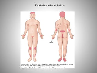 Psoriasis – sides of lesions
 